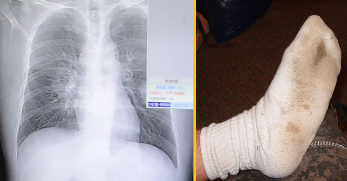 Mladý muž dostal pľúcnu infekciu po čuchaní vlastných ponožiek