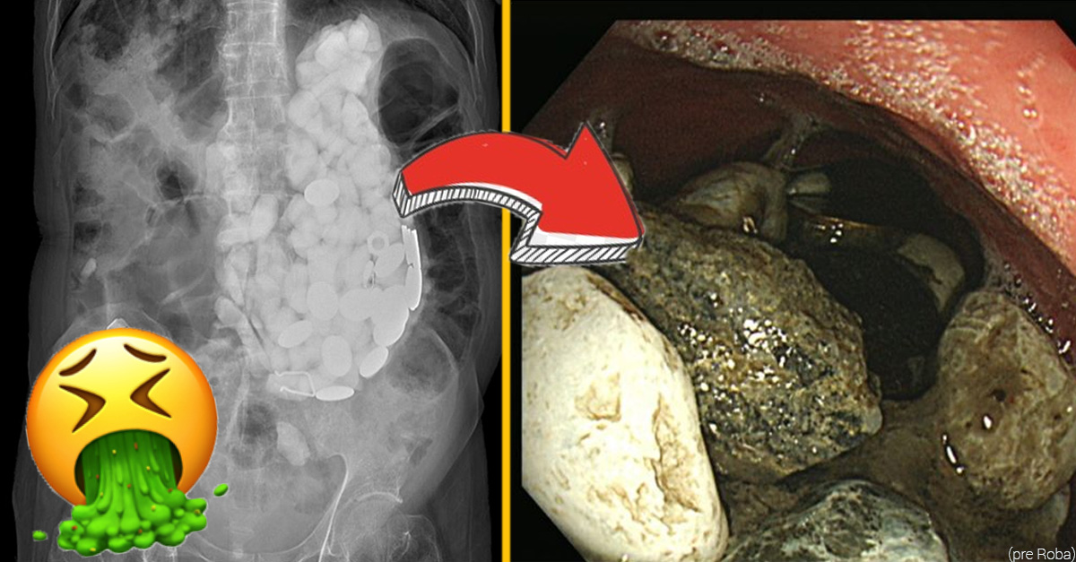 Doktori vyberali mužovi z brucha kamene, vrchnáky a mince- ten ich jedol, aby nimi liečil úzkosť