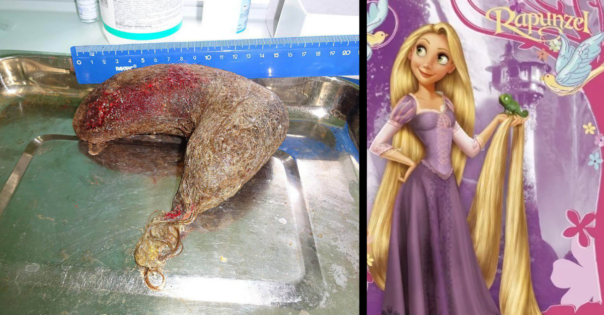 Doktori odstránili dievčaťu zo žalúdka 0,5 kg chumáč vlasov