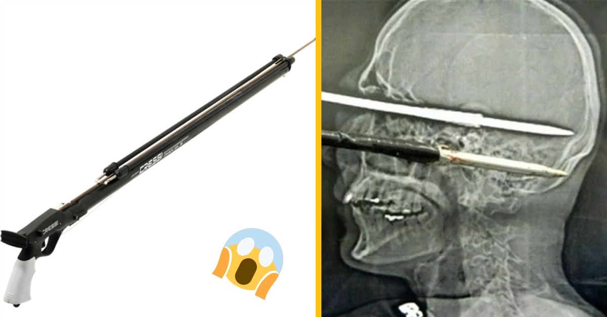 Muž si omylom kompletne prestrelil hlavu harpúnou  a zázračne prežil