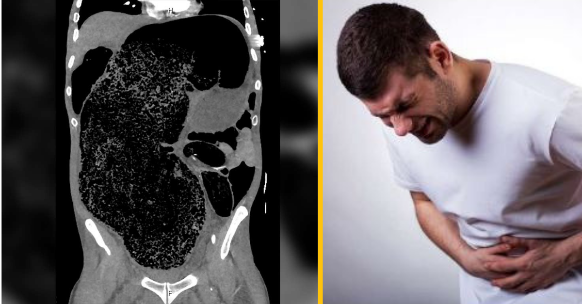 Mužovi kvôli kolosánemu h*vnu v jeho črevách ochrnula noha a skoro zomrel