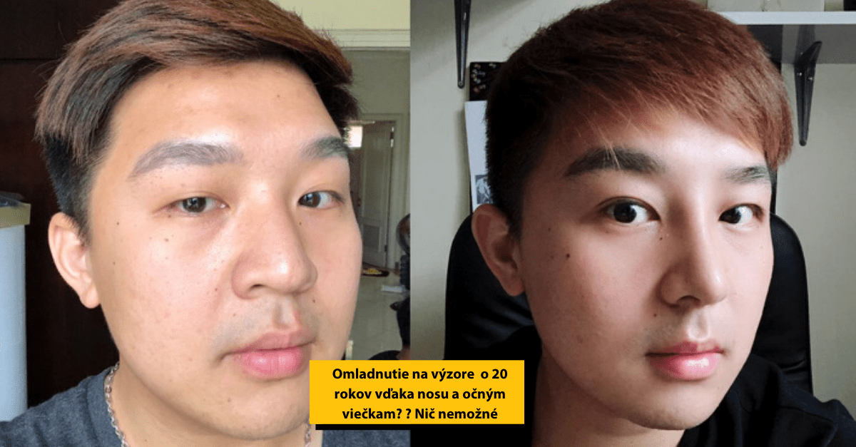 9 prípadov, kedy plastická operácia dokáže skrášliť človeka na nepoznanie