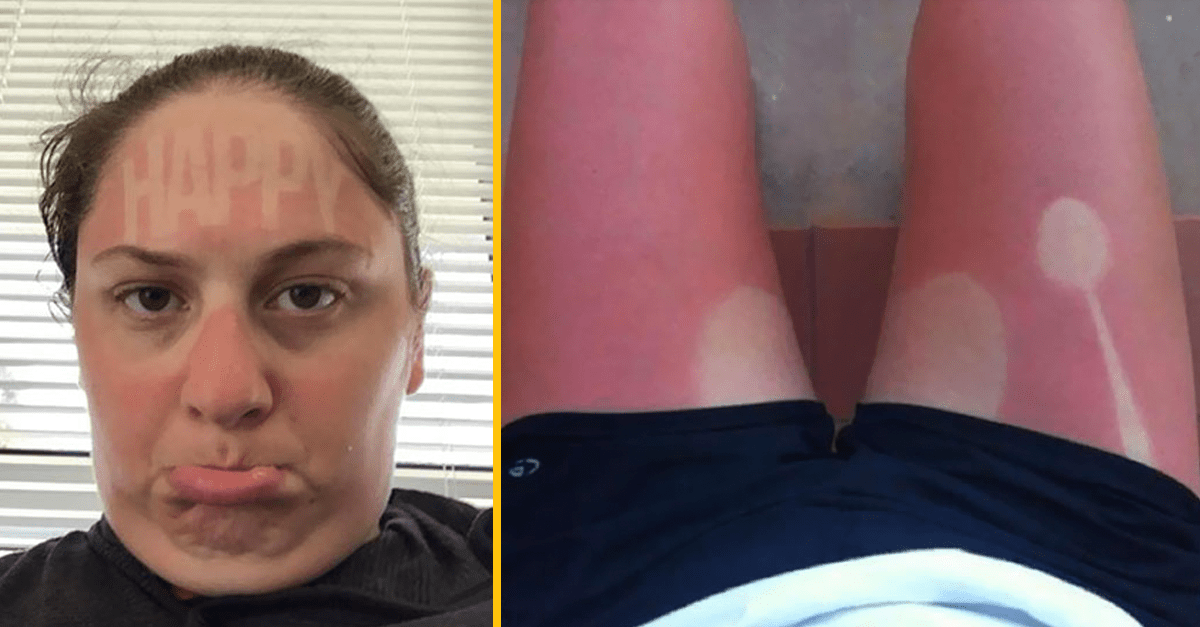 Niekoľko zábavných prípadov, kedy ľudia podcenili silu slnka a poriadne sa spálili