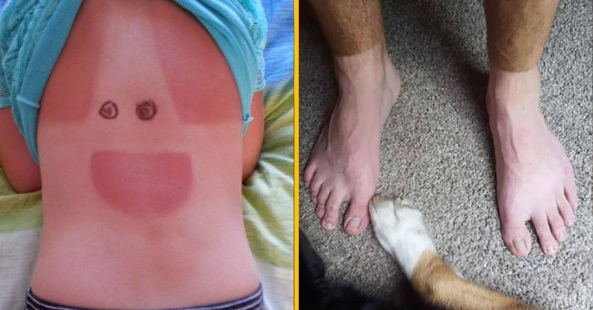 12 ľudí, ktorí podcenili silu opaľovacieho krému a slnka