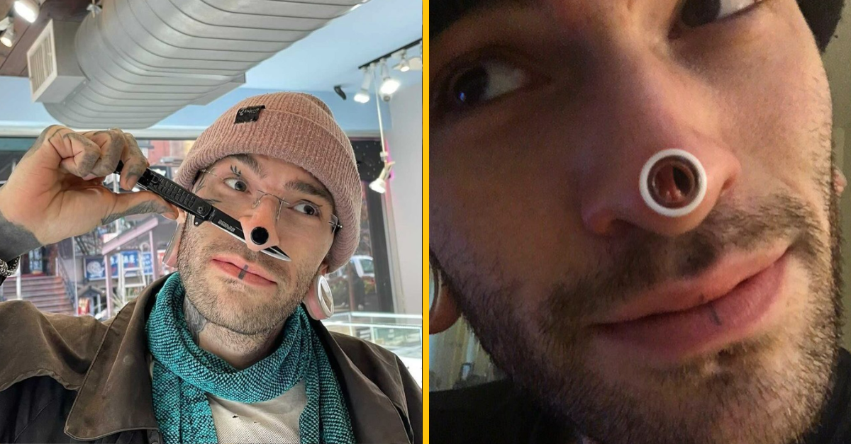 Muž si dal odstrániť špičku nosa. Nie je to však jediné, čo si na jeho vzhľade hneď všimnete