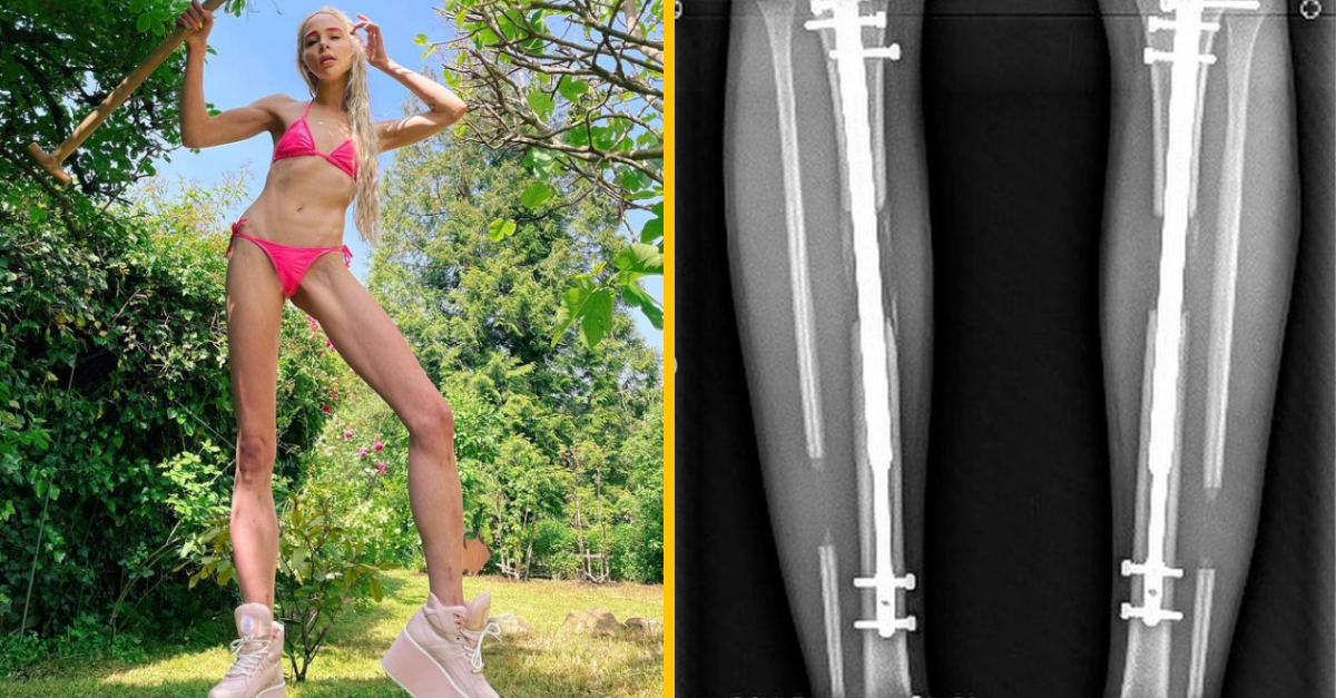 Modelka si nechala predĺžiť nohy o 15 centimetrov. Teraz to ľutuje a je zahanbená. Neurobila to kvôli sebe