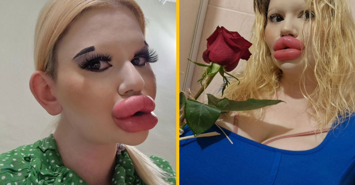 Žena s najväčšími perami na svete má problém s randením. Muži sa jej vraj boja