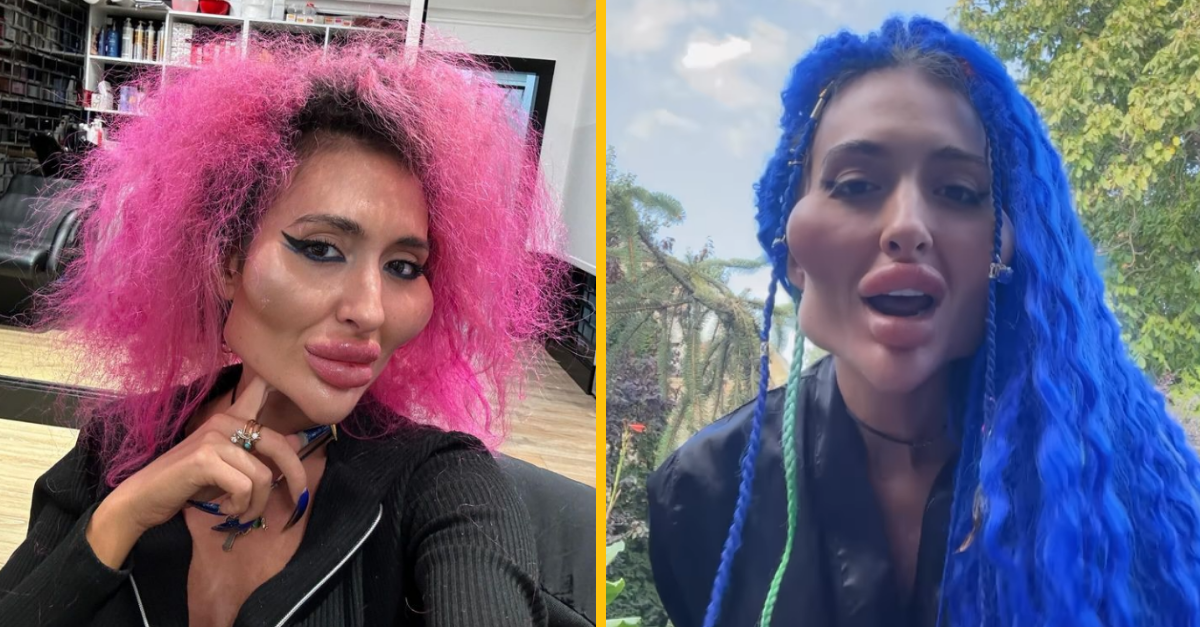 Žena s najväčšími lícami sa cíti unikátna. Ľudia ju skôr považujú za desivú a odkazujú jej, aby si neubližovala