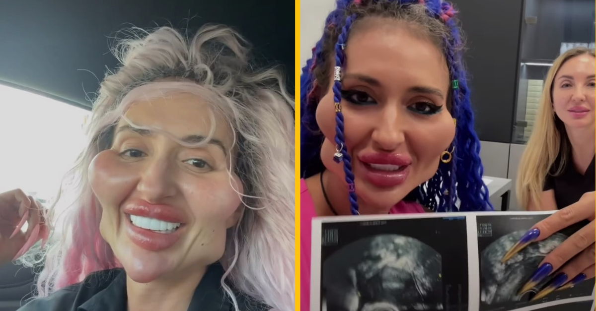 Modelka s najväčšími lícnymi kosťami na svete verejne priznala, že má zdravotné problémy a to predovšetkým pri svojich pokusoch otehotnieť