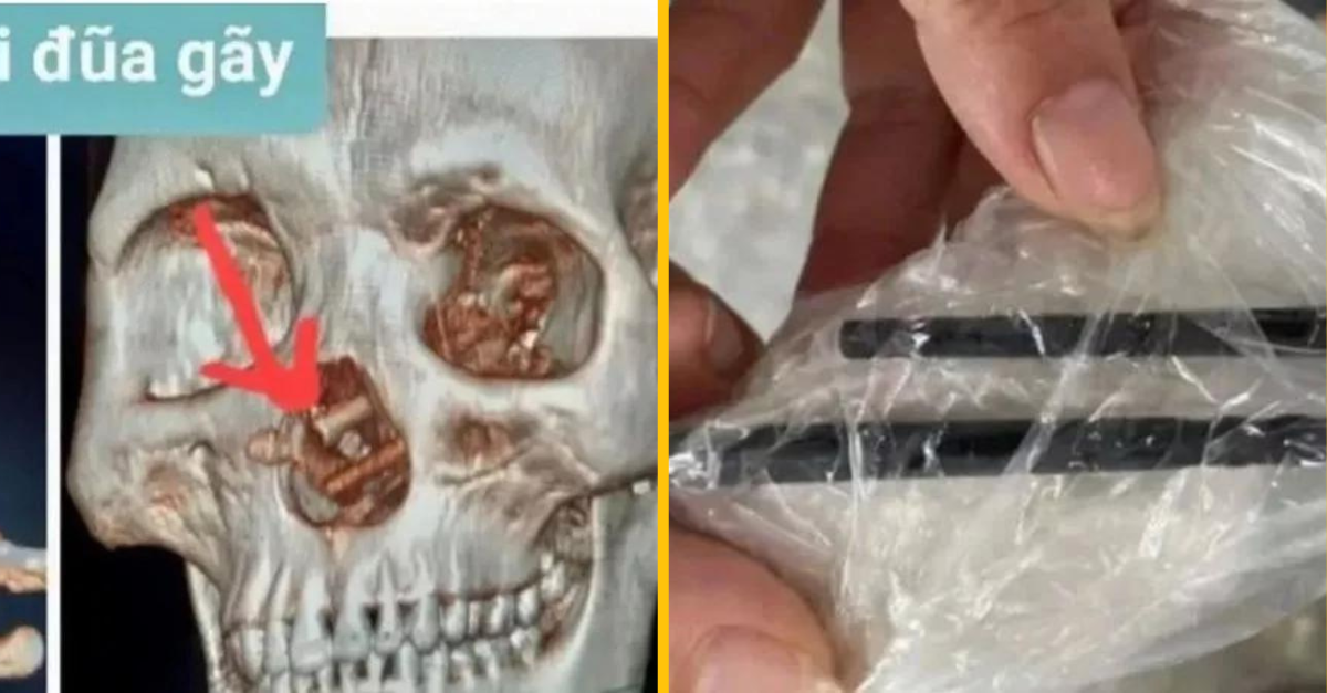 Mužovi nevedeli zistiť príčinu bolesti hlavy, až dokiaľ mu v lebke nenašli zarazené čínske paličky