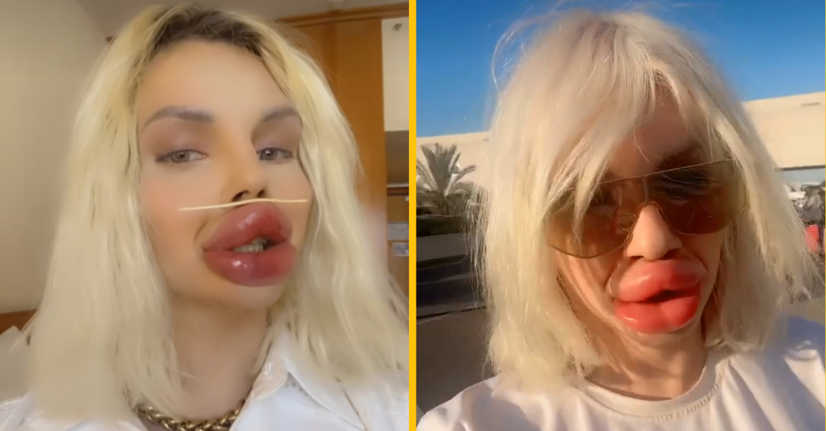 Modelka s najväčšími perami v Európe sa sťažuje, že má kvôli nim problémy problémy sa najesť a napiť