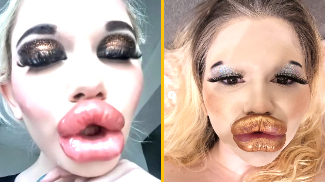 Žena s najväčšími perami na svete si ako predčasný vianočný darček podarovala ďalšie zväčšenie pier