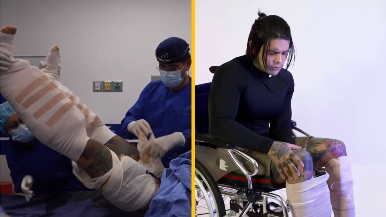 Muž minul viac ako 160 000 eur na bolestivú operáciu, aby bol o 15cm vyšší