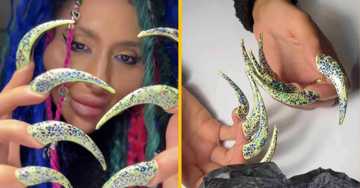 Žena s najväčšími lícnimi kosťami na svete sa chváli ďalším estetickým prešľapom