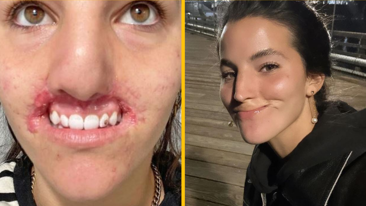 Pri útoku Pitbulla prišla o celú pery a podelila sa o svoju zotavovaciu cestu