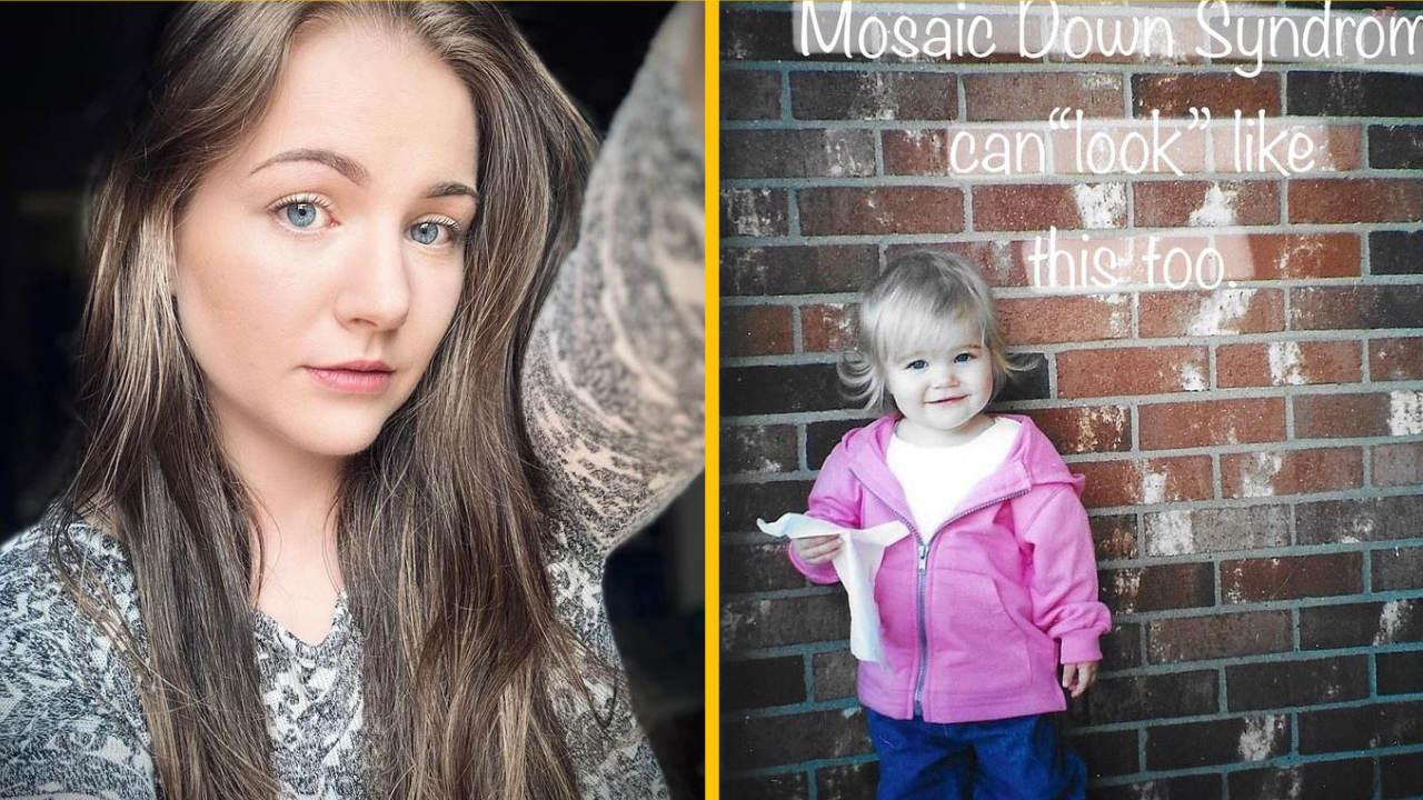 Až do jej 23 rokov netušila, že má Downov syndróm. Toto sú príznaky, ktoré roky ignorovala