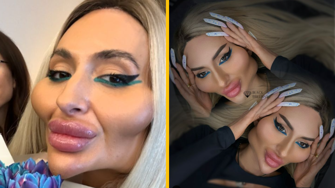 Žena s najväčšími lícami na svete hovorí: „Neprajníci hovoria, že nikto by ma nenazval peknou, ale milujem svoj vzhľad“