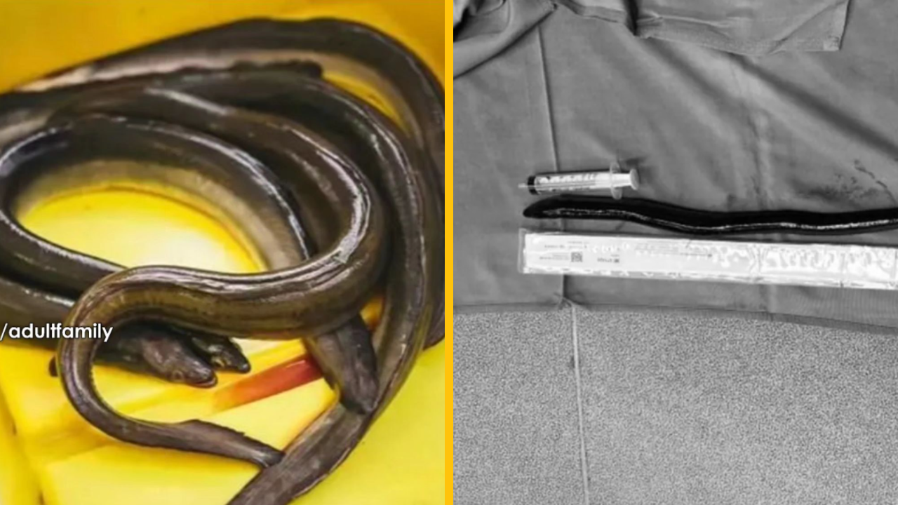 Lekári na pohotovosti odstránili mužovi z brucha živého úhora