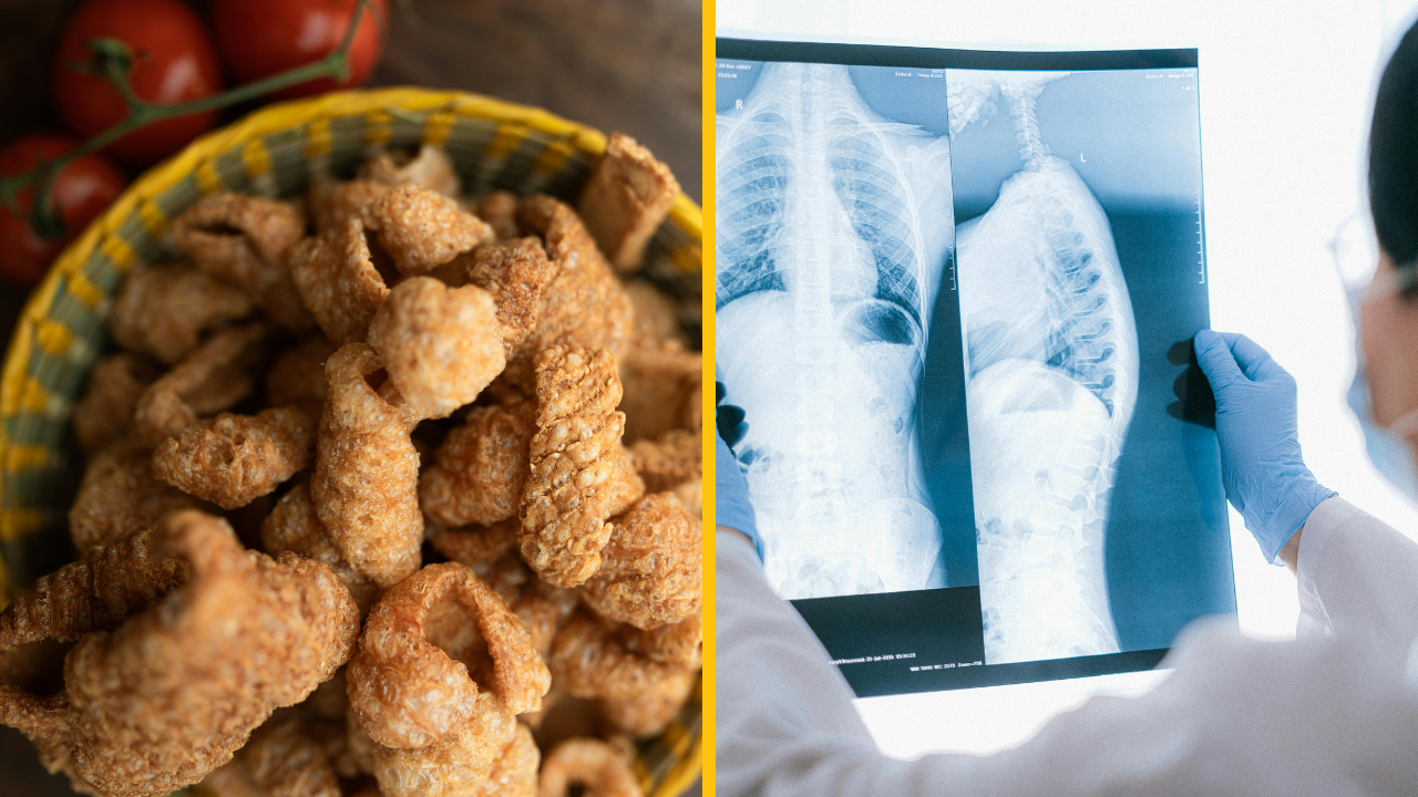 Žene museli po zjedení bravčovej kože zachraňovať život v nemocnici