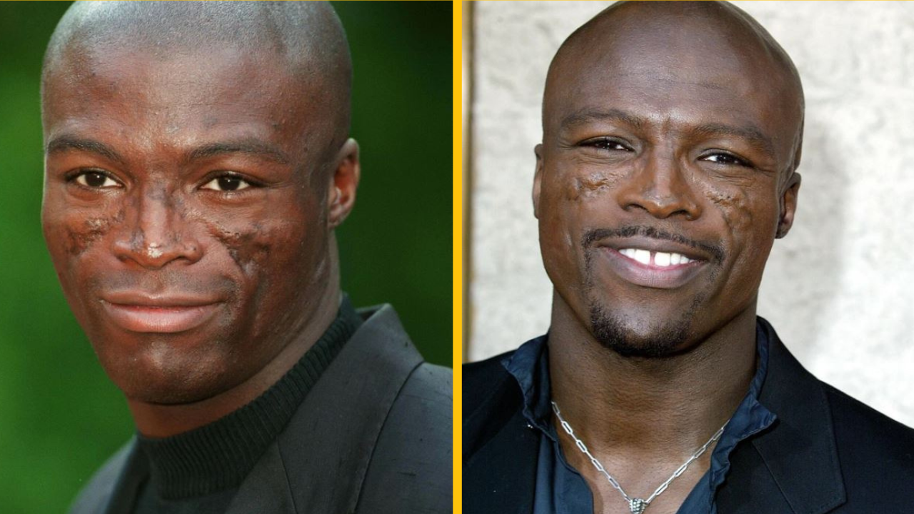 Seal prehovoril o traumatizujúcich jazvách na jeho tvári a o ich pôvode