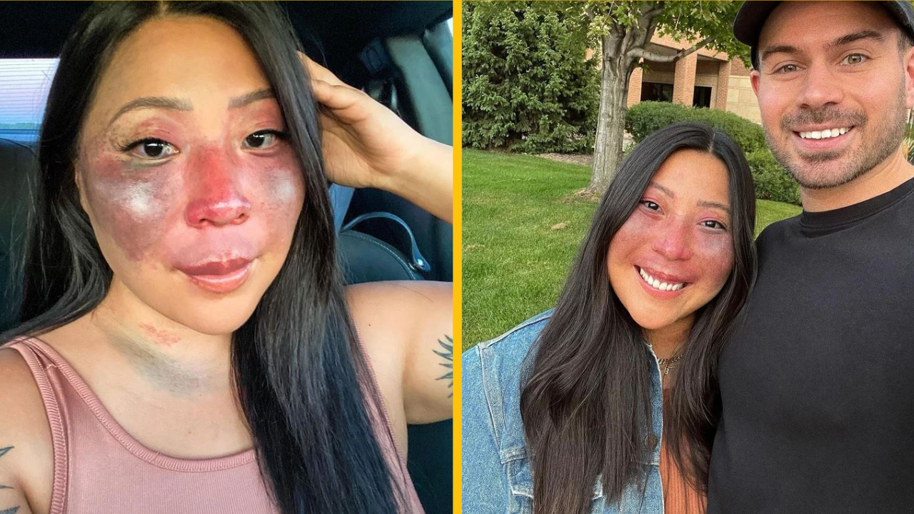 Žena s veľkým materským znamienkom na tvári hovorí o tom, aké to je, keď sa na vás ľudia stále pozerajú