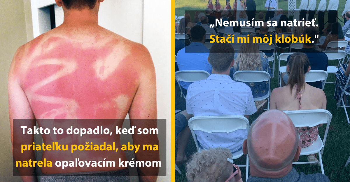 14 fotografií ľudí, ktorí podcenili silu Slnka a nenatreli sa dostatočne opaľovacím krémom