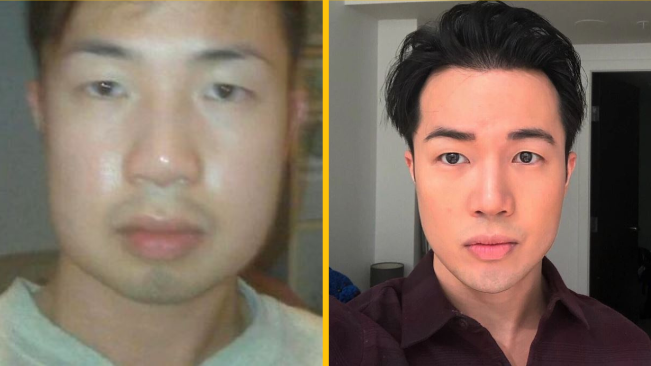 Tento muž sa podelil o pozoruhodné výsledky za 10 rokov návštev plastickej chirurgie