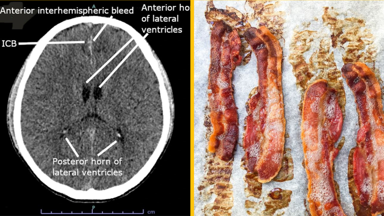 Vajcia červov objavené v ľudskom mozgu – dôvodom bola nedostatočne upečená slanina