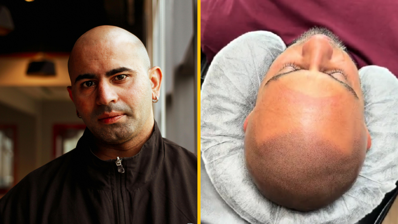 Holohlavý chlap si nechal vytetovať na hlavu vlasy a ľudia sú ohromení