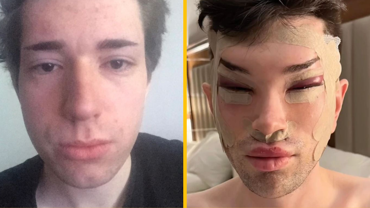 Muž odhalil dramatické výsledky na svojej ceste plastickou chirurgiou