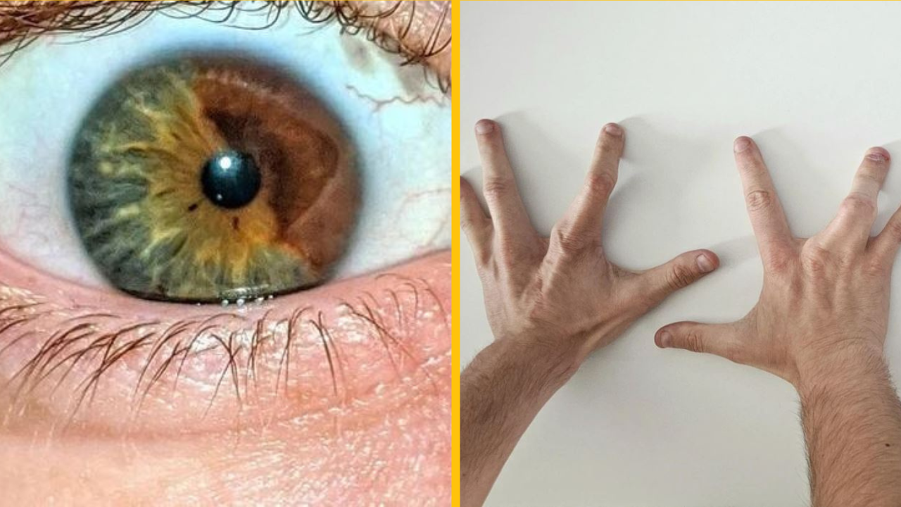 20 ľudí, ktorí sa hrdo podelili o svoje jedinečné telesné vlastnosti