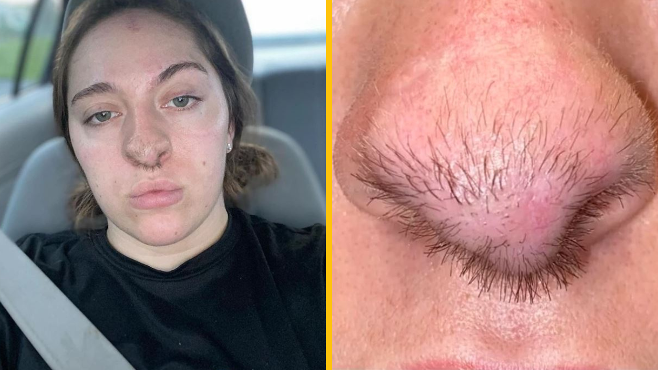 Napadol ma pes – teraz mi rastú chlpy na nose