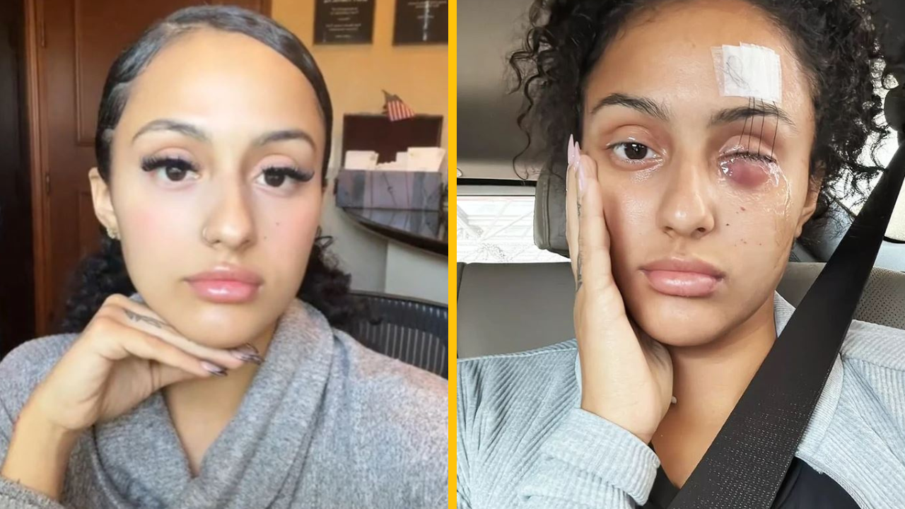 „Stále neverím, že je to pravda,“ žena prišla o oko kvôli vodítku pre psa – teraz varuje ľudí pred skrytými nebezpečenstvami