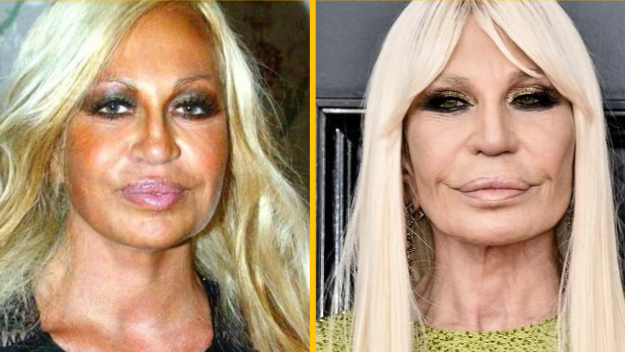 Ako sa týchto 10 celebrít zmenilo po absolvovaní kozmetických procedúr?