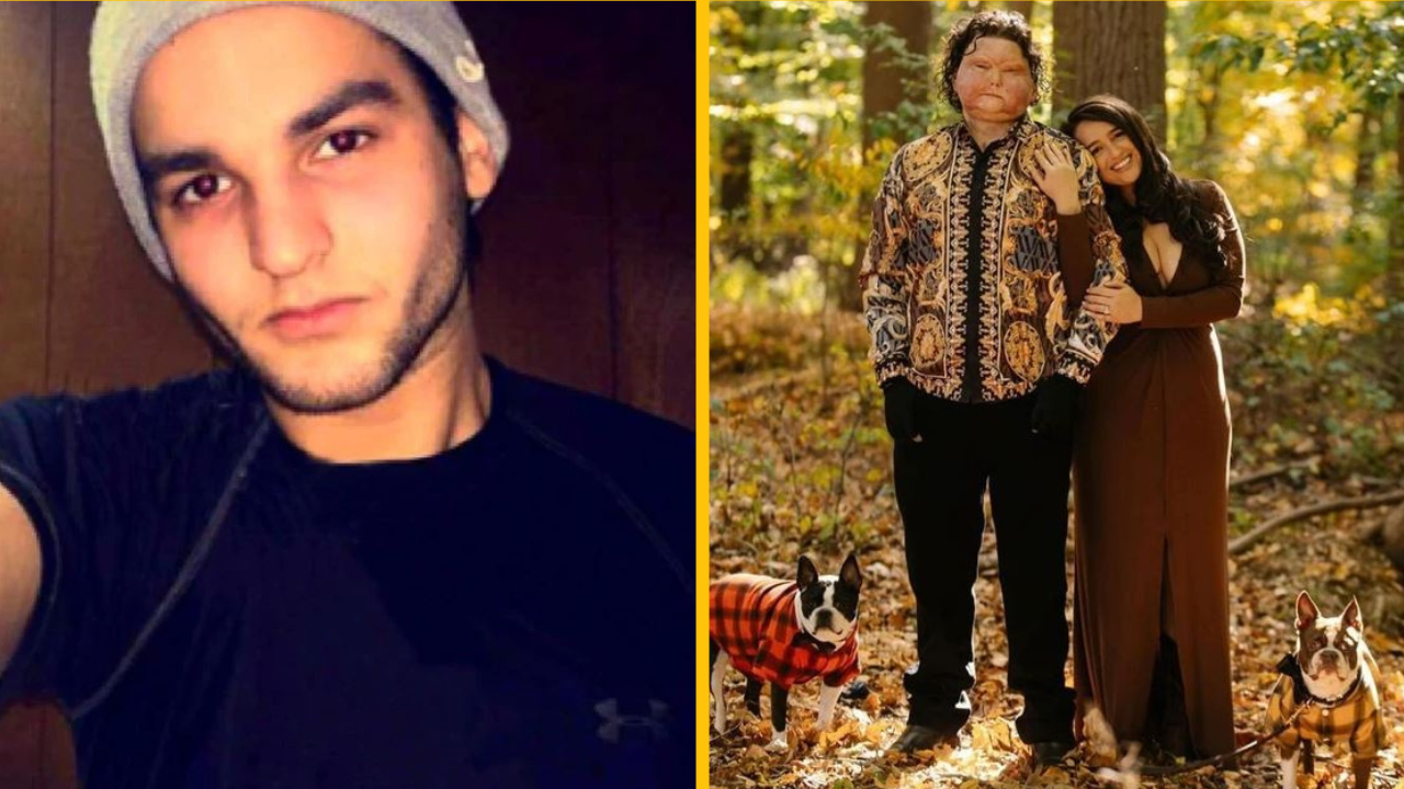 Muž, ktorý podstúpil prvú transplantáciu tváre na svete, konečne stretol svoju pravú lásku