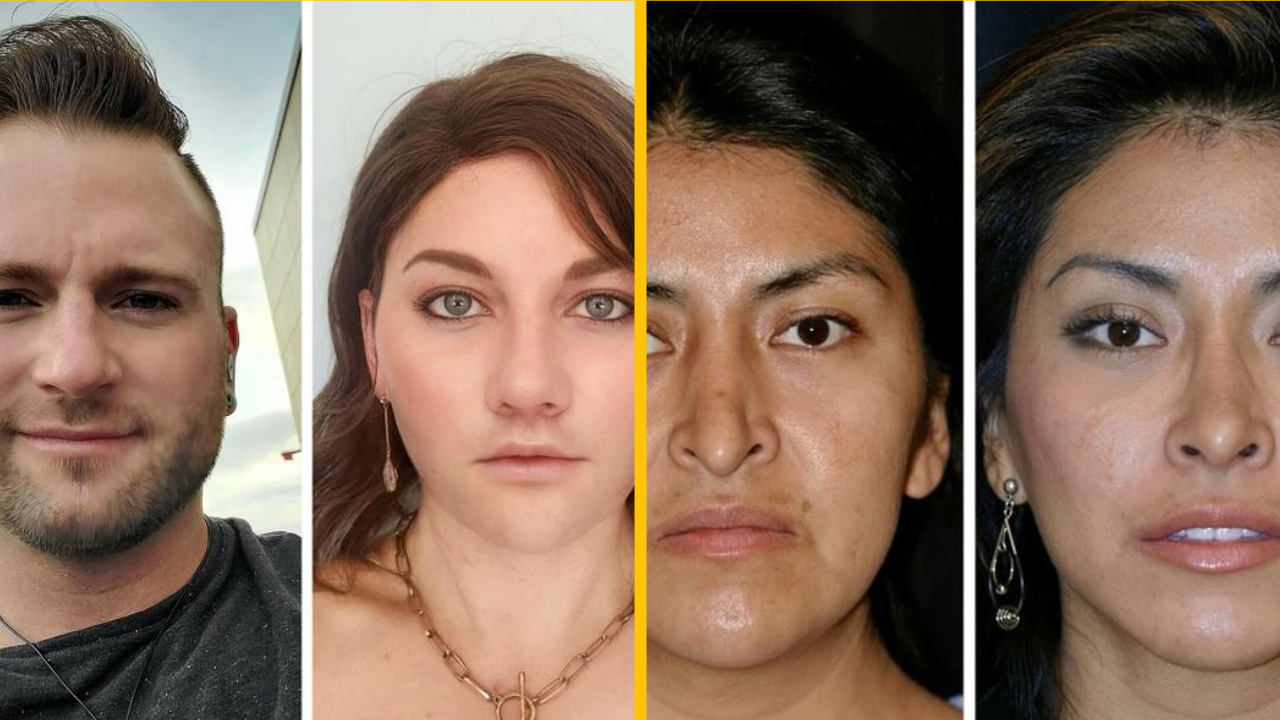 15 ľudí, ktorí sa rozhodli pre plastickú chirurgiu a sú nadšení svojím novým vzhľadom