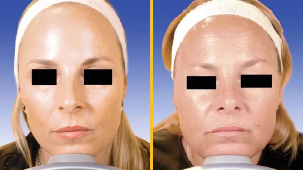 Rozdiel medzi identickými dvojičkami, kedy jedna 20 rokov používala botox a druhá nie