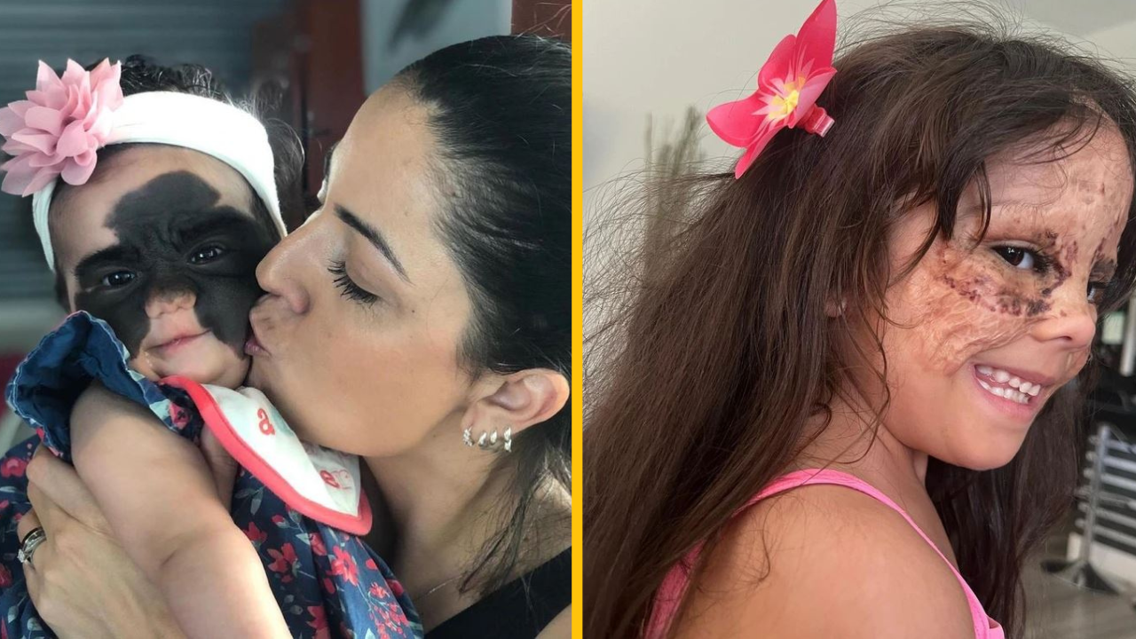 Dievčatko bolo šikanované a nazývané monštrom kvôli svojmu materskému znamienku