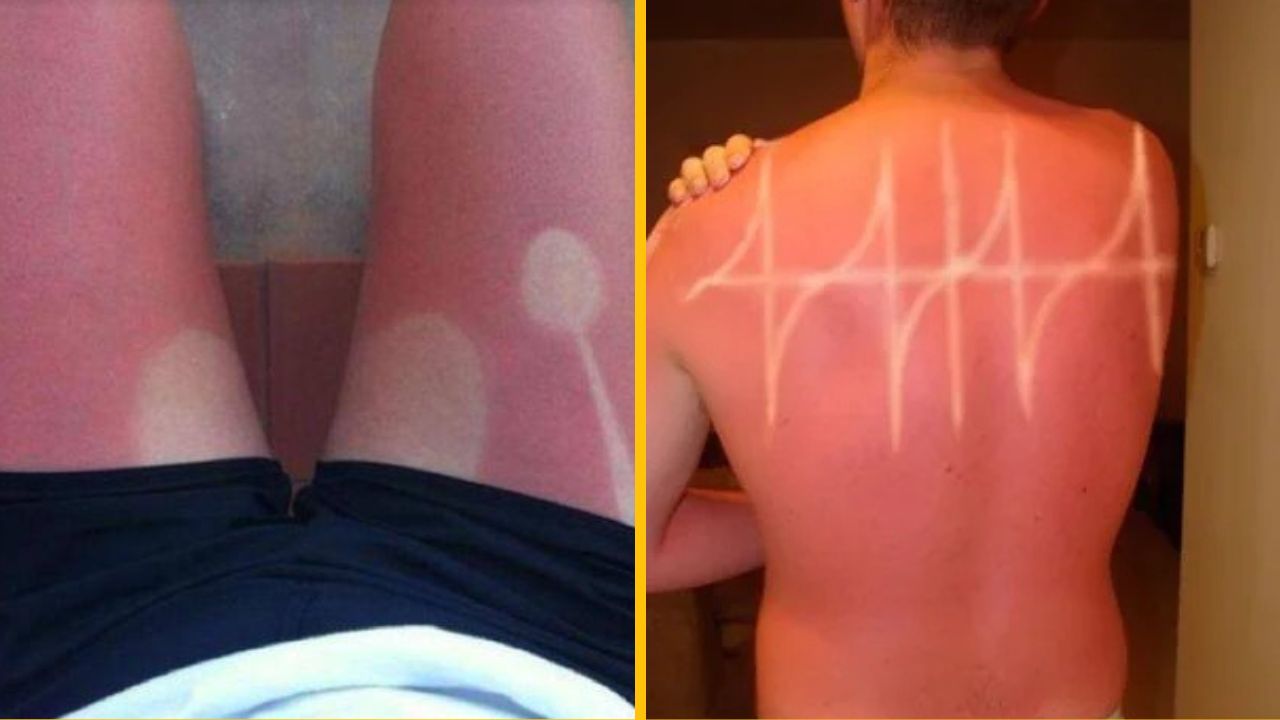 10 vtipných fotografií nešťastníkov, ktorých opálenie nedopadlo podľa predstáv #2