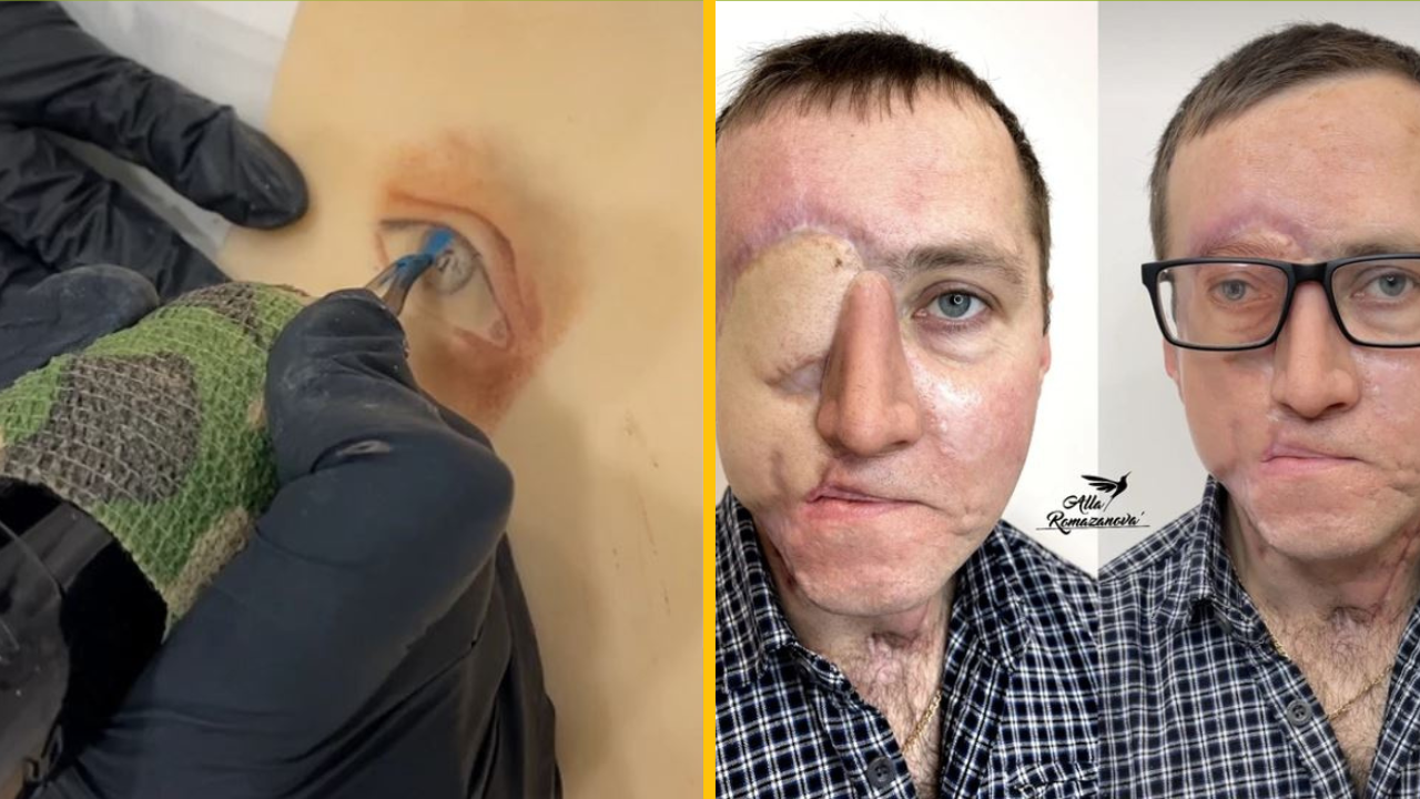 Tatérka vytvorila mužovi nové oko po tom, čo oň prišiel pri autonehode