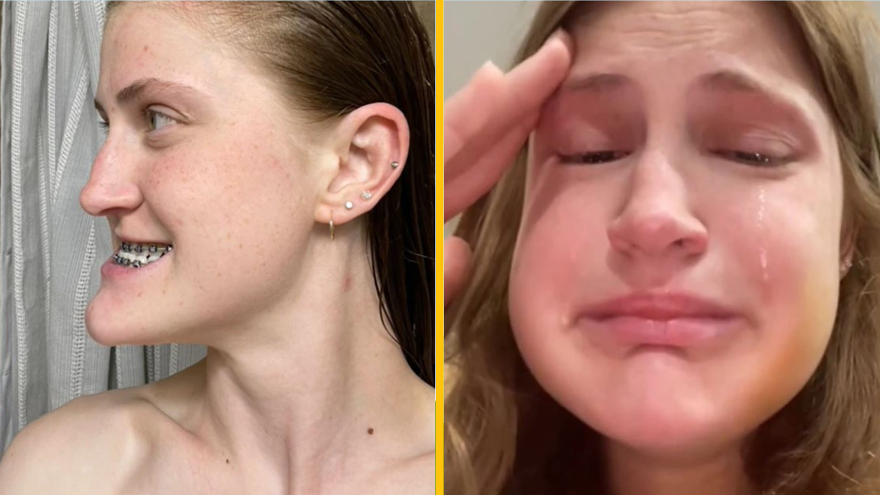 Mladá žena podstúpila operáciu dvojitej čeľuste, odstránili jej rovnátka a všetkých ohromila svojou úžasnou premenou