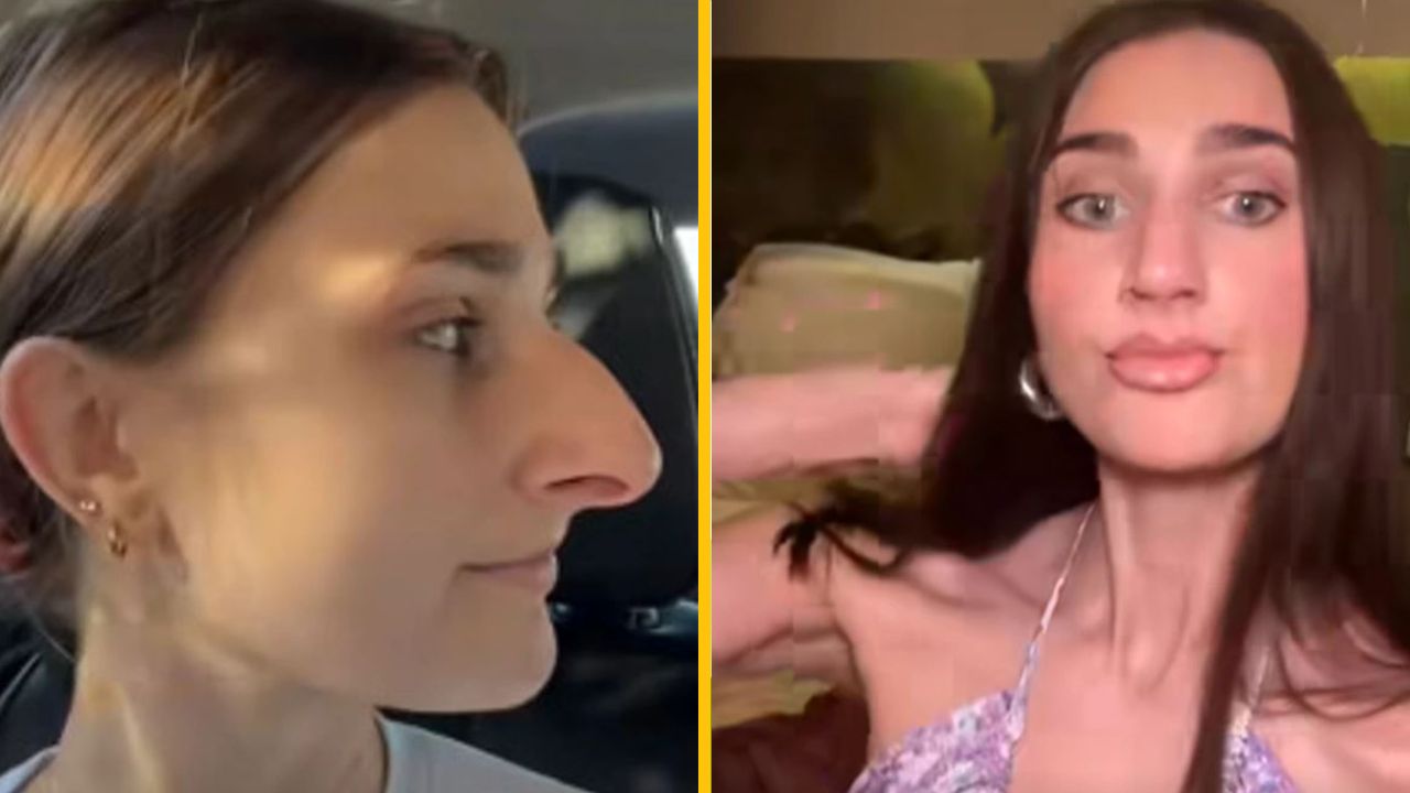 Po rokoch snívania konečne podstúpila operáciu nosa a výsledky sú neuveriteľné