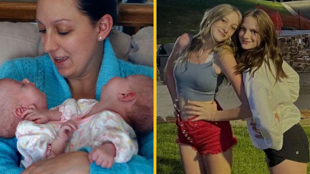 Šťastný príbeh zrastených dvojčiat, ktoré boli oddelené ako 6-mesačné a teraz sú stále spolu