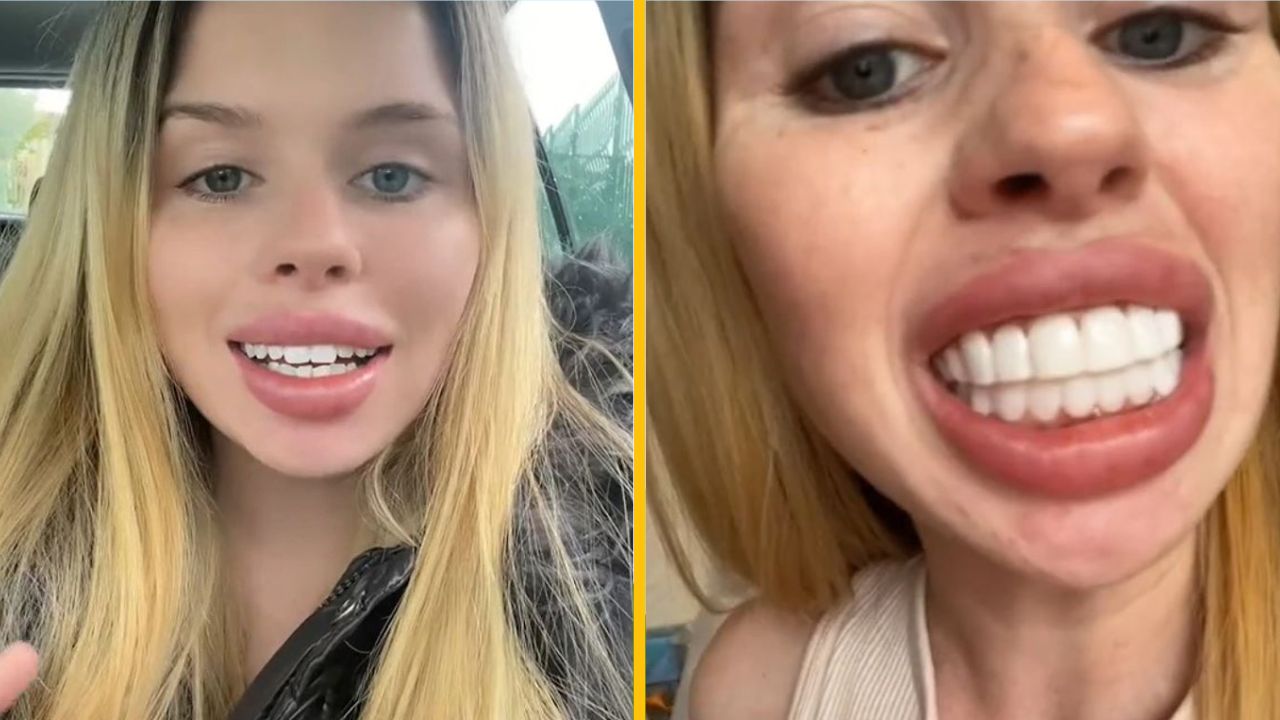 Žena si dala lacno spraviť nové zuby a reakcie na výsledok na seba nenechali dlho čakať