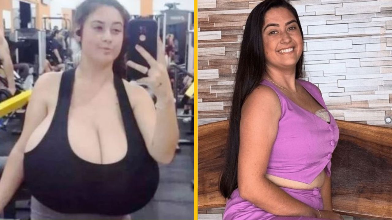 Operácia prsníkov s hmotnosťou 10 kg: Šokujúca realita gigantomastie