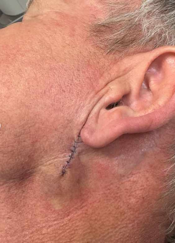 Jazva so stehmi za uchom na mužskej tvári po chirurgickom zákroku.