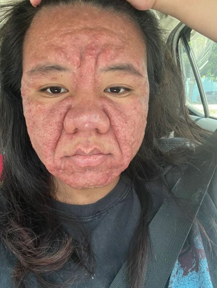 Ľudia s kožnými ochoreniami: Podrobnosti a osobné príbehy skutočných klientov pri bežnom každodennom živote.