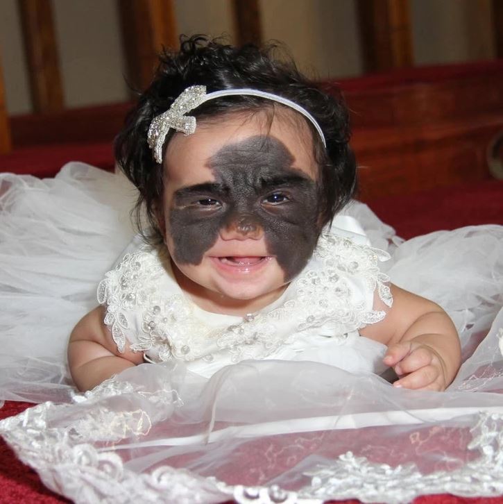 Dieťa v bielych šatách s veľkým znamienkom na tvári sa usmieva.