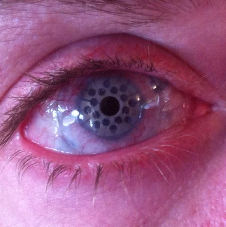 Oko s kontaktnou šošovkou s výrazným vzorom, detailný záber oka s jemne červeným okrajom viečka.