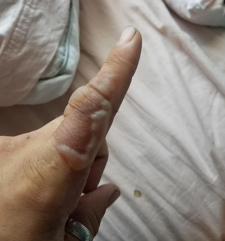 Ruka ukazujúca prst s opuchom na pokojnom pozadí; detailná fotografia zblízka.